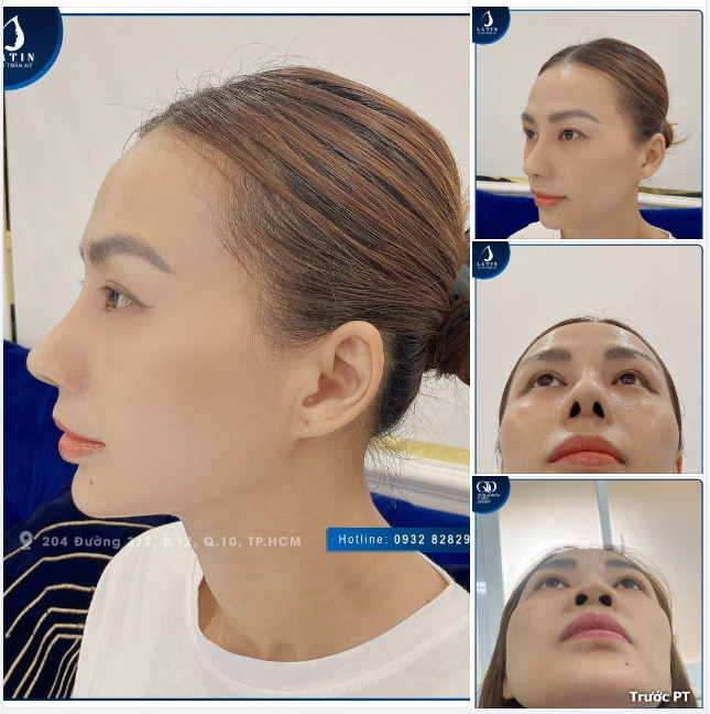 TÁI KHÁM MŨI SỬA LẠI SAU 10 NGÀY ĐẸP MÊ LY