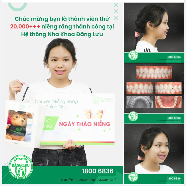 Mừng ngày tháo niềng Tạm biệt hành trình niềng răng hơn 2 năm