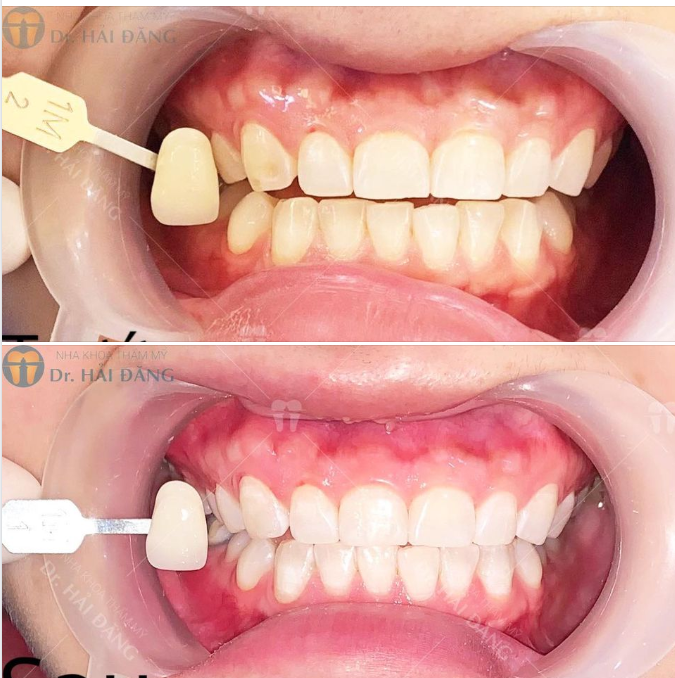 TẨY TRẮNG RĂNG TRONG THỜI GIAN BAO LÂU