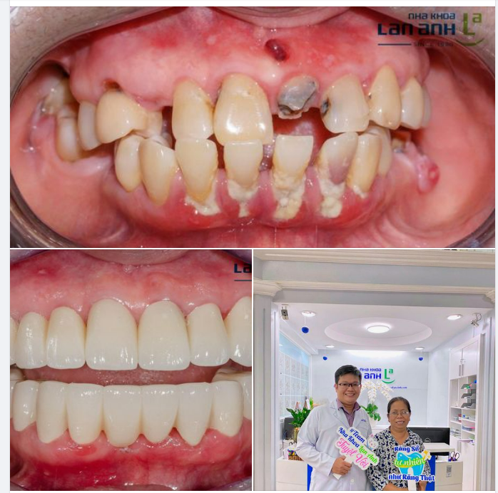 Cô đến theo lịch hẹn tái khám sau khi phục hình răng sứ toàn hàm.