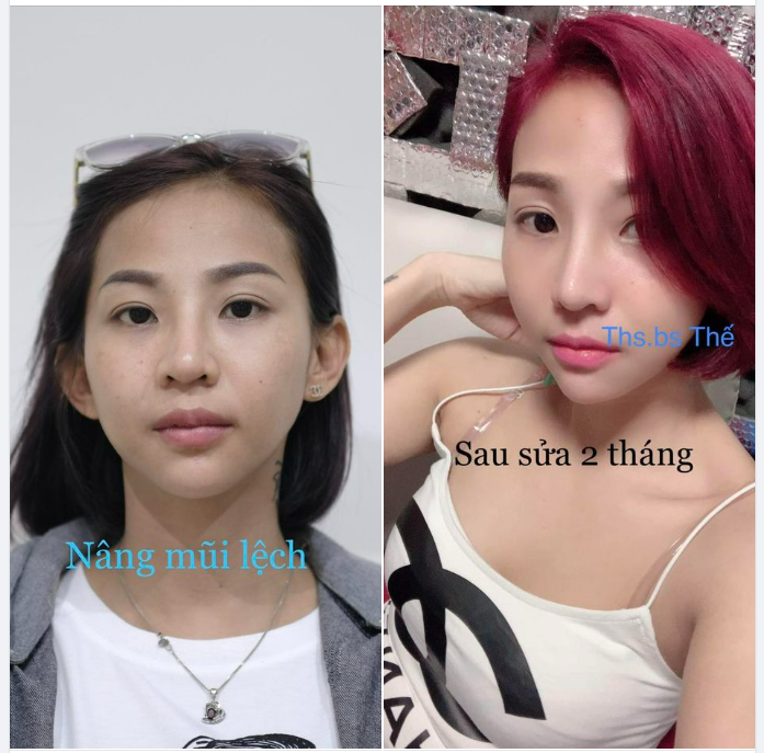 SỬA LẠI MŨI LỆCH