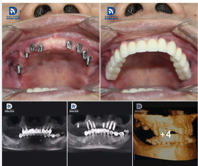 CASE THỰC TẾ 15 - KHỎE HƠN, TRẺ HƠN NHỜ 8 TRỤ IMPLANT PHỤC HÌNH TOÀN HÀM TRÊN