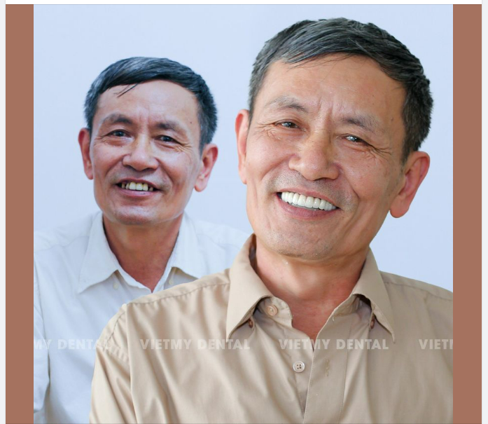 Chú Hùng 66 tuổi ở Hạ Long đến với Nha Khoa Quốc Tế Việt Mỹ trong tình trạng : 