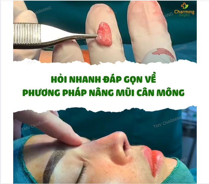 HỎI NHANH ĐÁP GỌN VỀ PHƯƠNG PHÁP NÂNG MŨI CÂN MÔNG