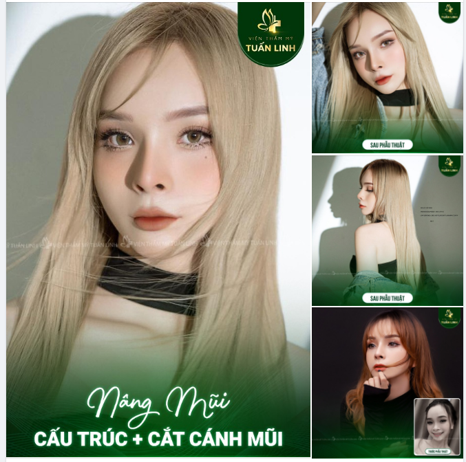 Nâng mũi cấu trúc + cuộn cánh mũi Cho dáng mũi đẹp hoàn hảo!!