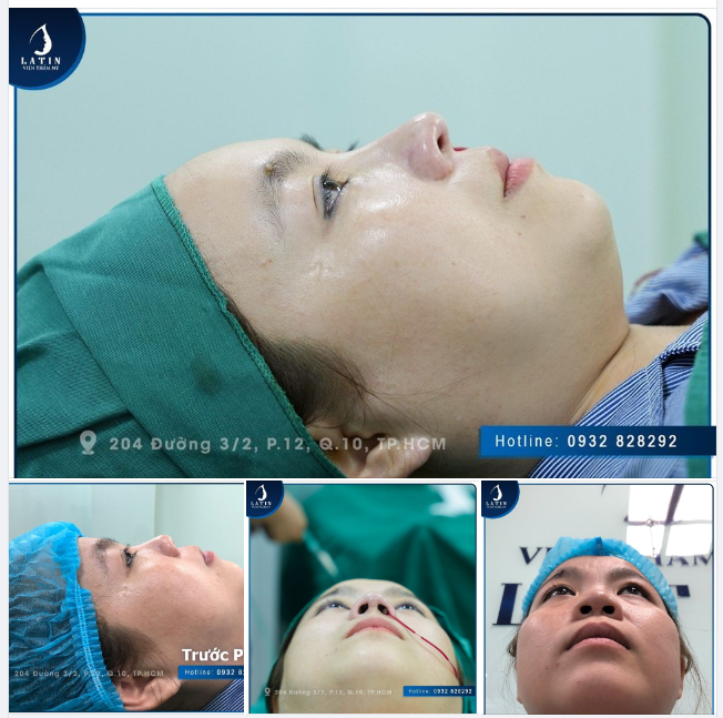 MŨI BÁN CẤU TRÚC TỰ NHIÊN CHO CHỊ GÁI ĐẾN TỪ TIỀN GIANG