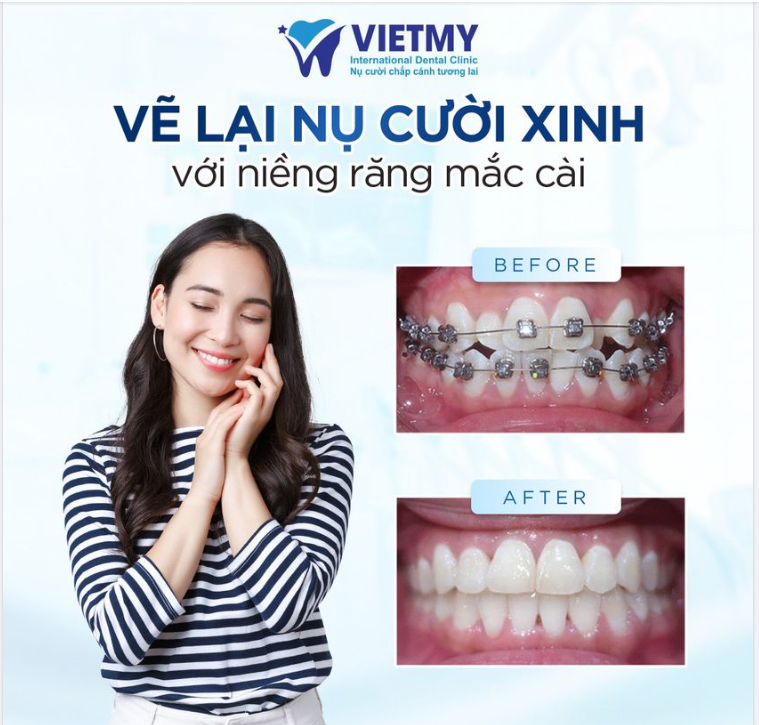 7 NỖI ĐAU SẼ BIẾN NGAY LẬP TỨC SAU KHI NIỀNG RĂNG TẠI NHA KHOA QT VIỆT MỸ