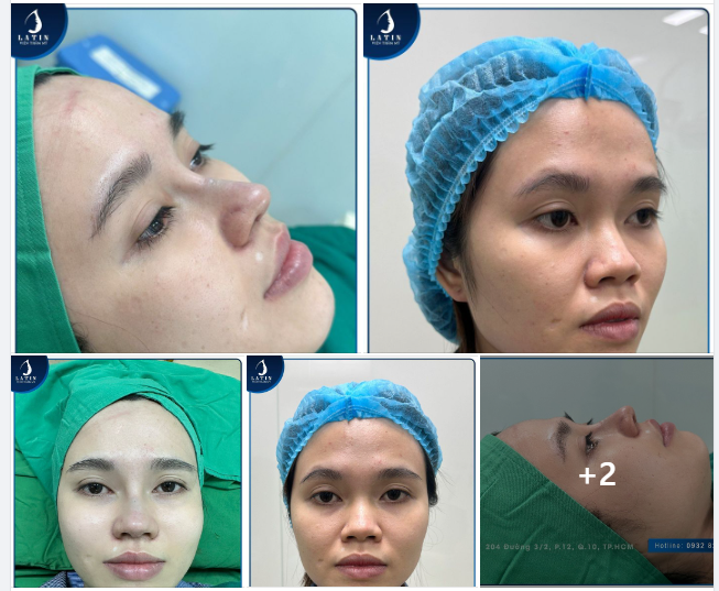 MŨI CẤU TRÚC SURGIFORM MỚI LÀM XONG LÊN FORM XUẤT SẮC