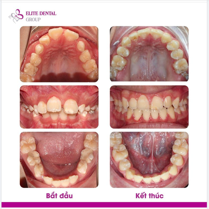 Chỉnh hô từ 9 tuổi, thay đổi hoàn toàn tình trạng hô răng, hô xương