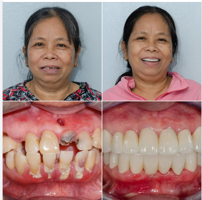Một ca điều trị toàn diện tại chi nhánh 288/1 Huỳnh Văn Bánh, do bác sĩ Thắng điều trị!