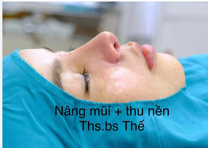 Khách hàng nâng mũi, giờ quay lại thu nền để làm nhỏ lỗ mũi