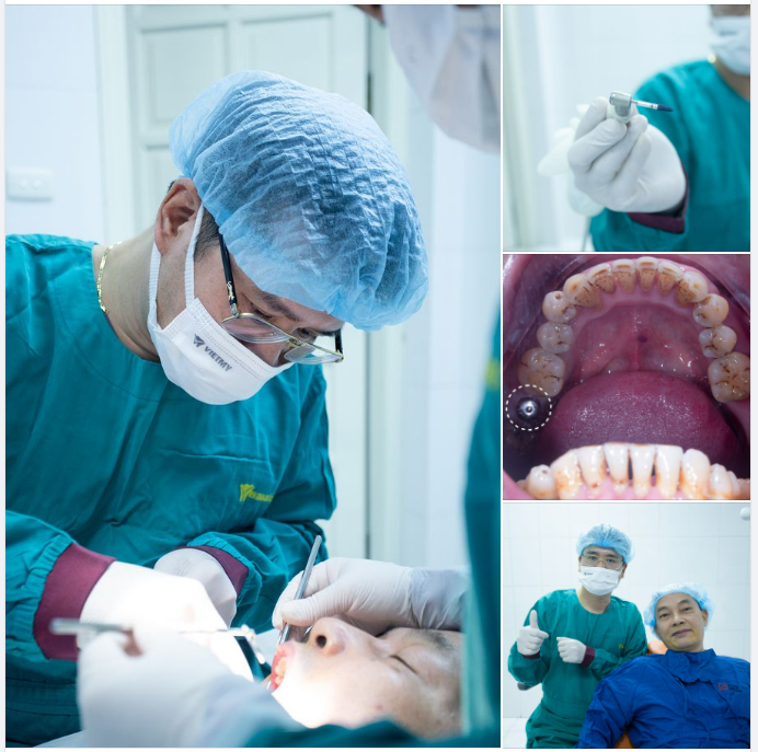 Hoàn thành case trồng răng Implant khôi phục răng hàm ăn nhai cho khách hàng Trần Mạnh Cường đến từ Hà Nội bằng phương pháp Xâm lấn tối thiểu với những ưu điểm vượt trội: