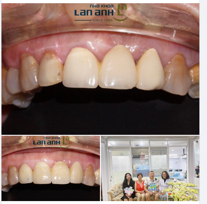Một ca điều trị làm lại cầu răng sứ của bác sĩ Thái Hoà, chi nhánh 288/1 Huỳnh Văn Bánh, P.11, Q.PN!