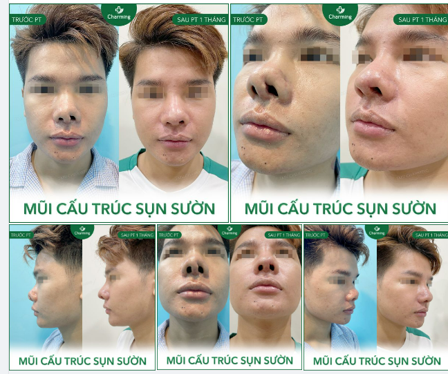 Sau khi phẫu thuật, chiếc mũi ngắn, mất cân đối của chàng khách đã trở nên hài hoà hơn, không còn là chiếc mũi "độc lạ" mà đã trở thành chiếc mũi "đẹp mã" đó nhaaa
