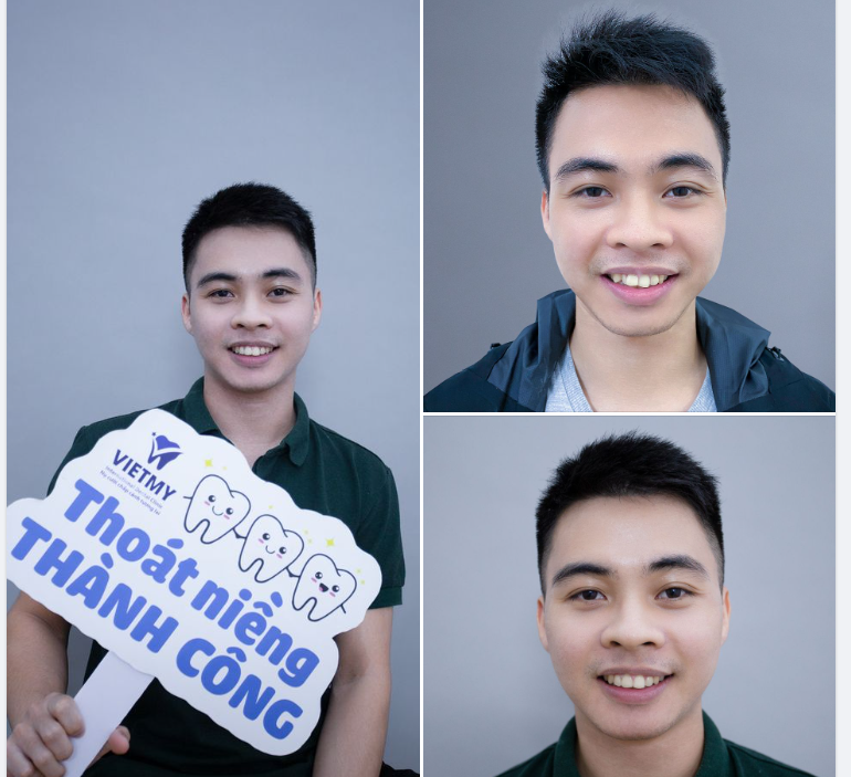 Khách hàng Thanh Hưng đã niềng răng 24 tháng và mới thực hiện tháo mắc cài nhé !