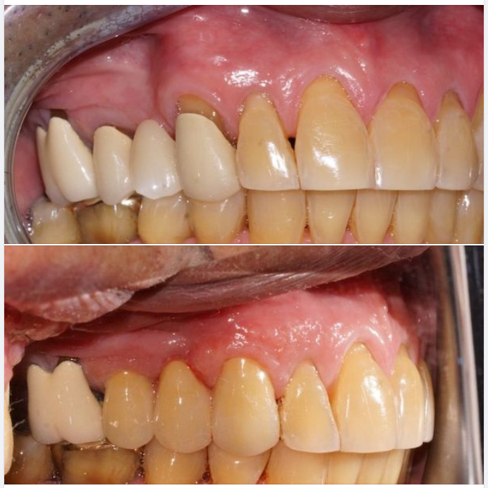 Một ca làm lại cầu răng sứ từ nơi khác tại chi nhánh 288/1 Huỳnh Văn Bánh, do bác sĩ Nguyên Anh điều trị!