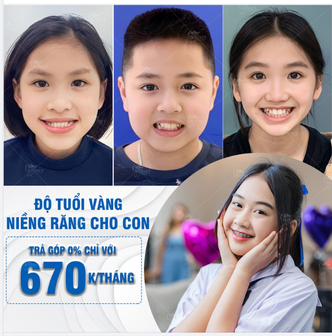 Hè rồi, niềng răng thôi!