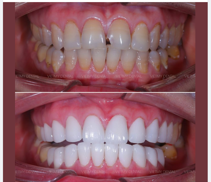 Với sứ mệnh chăm sóc và hoàn thiện nụ cười, qua kỹ thuật thẩm mỹ răng sứ nhẹ nhàng, không ê buốt, đảm bảo an toàn sức khỏe.