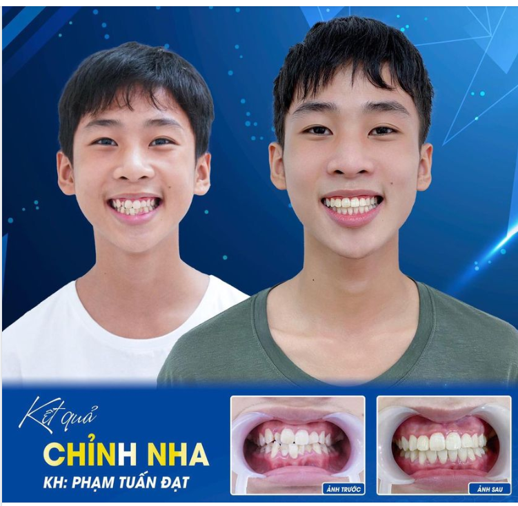 Hoàn thành case chỉnh nha cho khách hàng Phạm Tuấn Đạt.