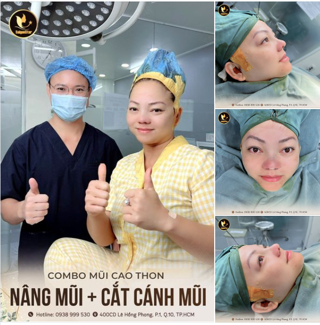 COMBO MŨI CAO THON: NÂNG MŨI + CẮT CÁNH MŨI