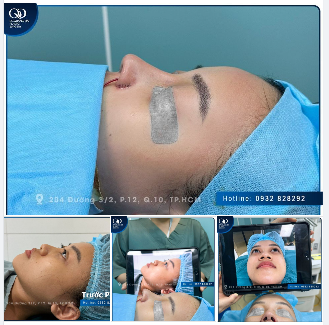 EM GÁI ĐẾN TỪ TÂY NINH VÔ CÙNG HÀI LÒNG VỚI KẾT QUẢ NÂNG MŨI