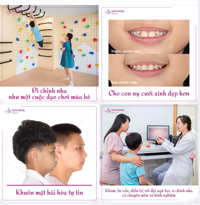 NGHỈ HÈ RỒI, NIỀNG RĂNG THÔI