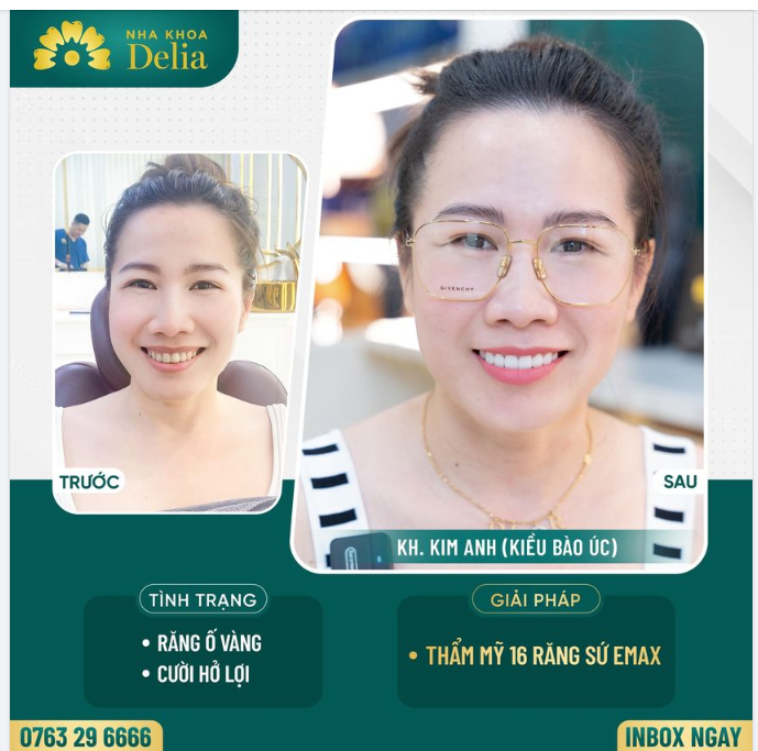 Chị Kim Anh (Định cư tại Úc) đến với nha khoa Delia