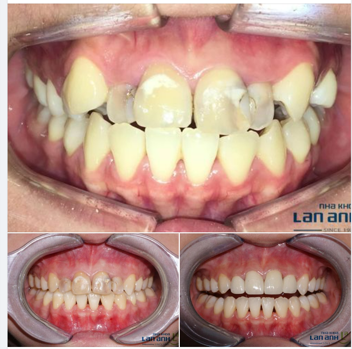 Hình ảnh 1 ca điều trị được thực hiện bởi Bác sĩ Thanh Huyền- chi nhánh 288/1 Huỳnh Văn Bánh.