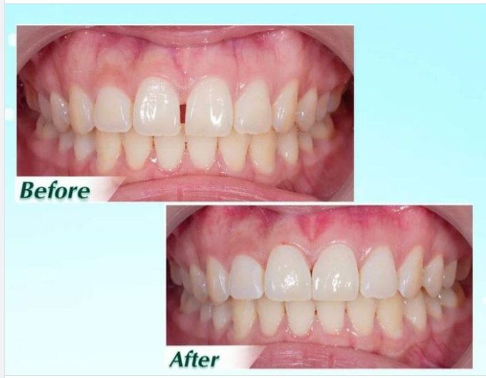Điều trị răng thưa bằng : 1: Trám thẩm mỹ Composite. 2: Dán sứ Venner / bọc răng sứ thẩm mỹ 3: Niềng răng