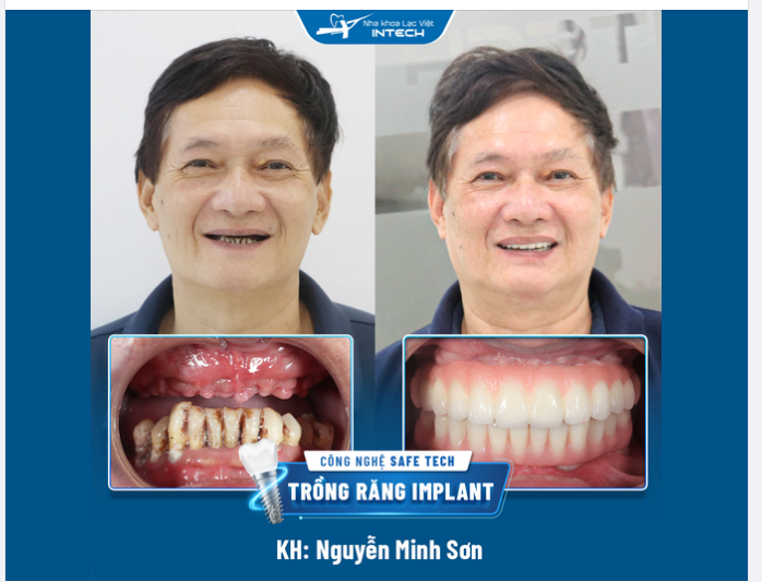 “Trồng răng xong thấy cuộc sống phấn khởi hẳn, ăn uống cũng ngon hơn…”