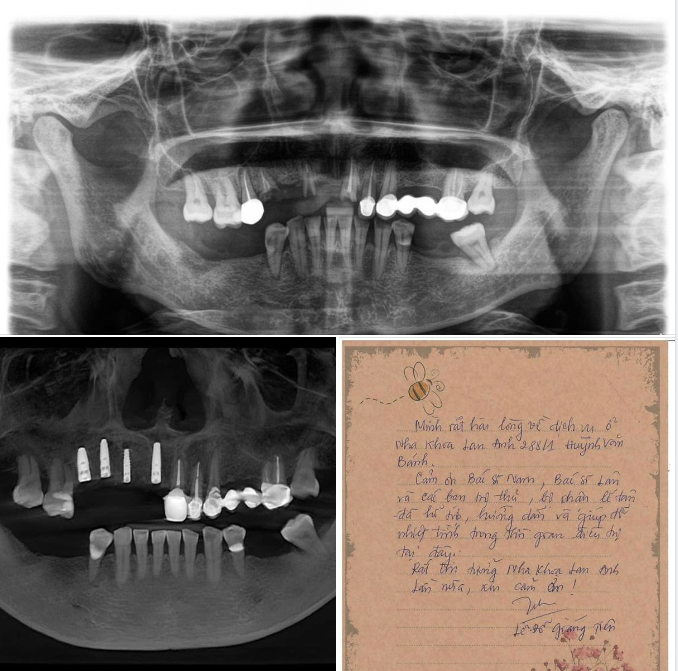 ĐẶT TRỤ IMPLANT CHO VÙNG RĂNG CỬA.