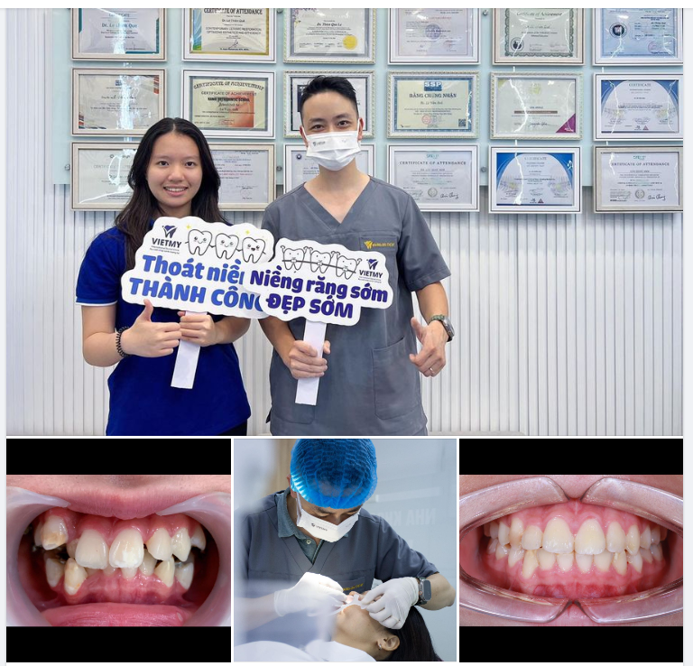Case chỉnh nha được hoàn thành cho khách hàng Nguyễn Hạ Vy có tình trạng răng khấp khểnh, lệch khớp cắn.