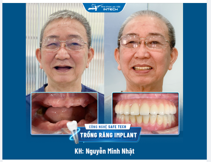 “Cảm ơn Nha khoa Lạc Việt Intech đã giúp tôi có một hàm răng đúng nguyện vọng…”