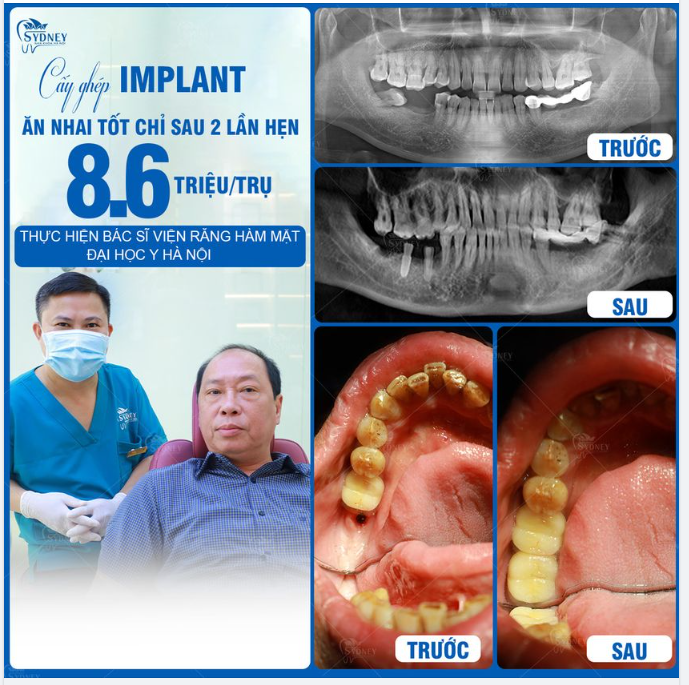 CẤY GHÉP IMPLANT - CHỈ 8,6 TRIỆU/TRỤ
