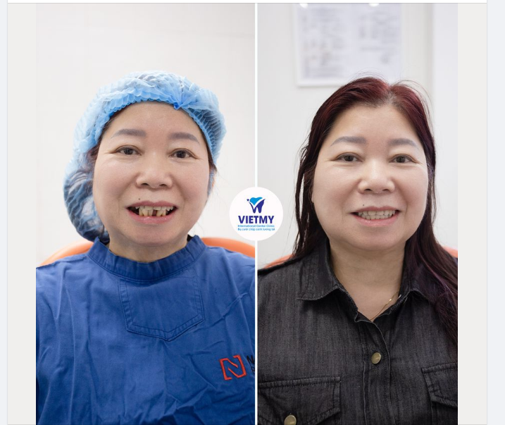 Trồng răng implant hiện nay đã không còn trở nên xa lạ với mọi người.