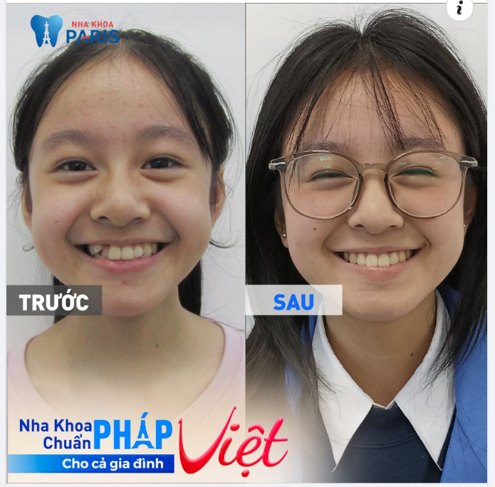 Bé Nguyễn Linh Đan, sau 20 tháng niềng răng tại nha khoa Paris.