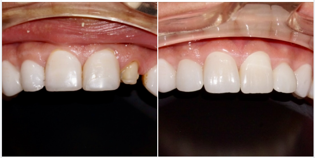 Mặt dán sứ Veneer làm tại nơi khác và sau khi điều trị lại tại nha khoa Lan Anh.