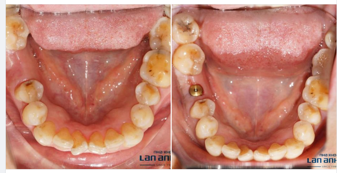 MẤT RĂNG, ĐỪNG LO! ĐÃ CÓ GIẢI PHÁP IMPLANT.