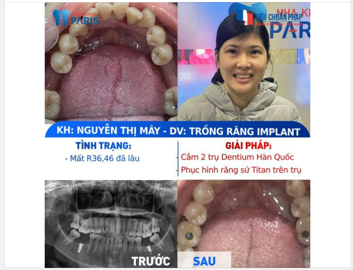 PHÂN TÍCH LÂM SÀNG CA MẤT RĂNG LÂU NĂM