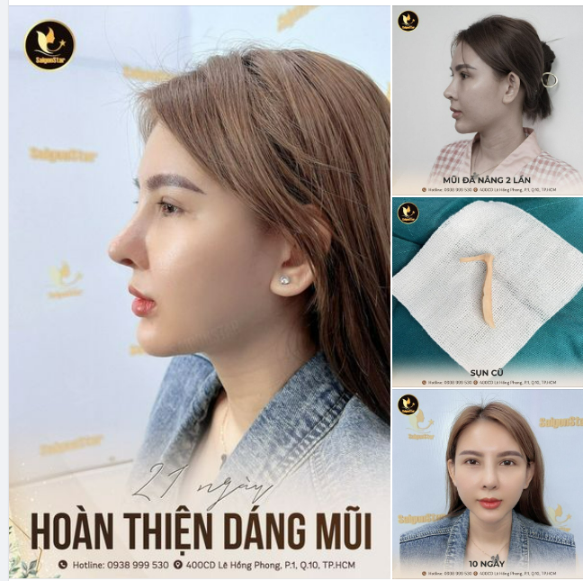 21 NGÀY HOÀN THIỆN DÁNG MŨI