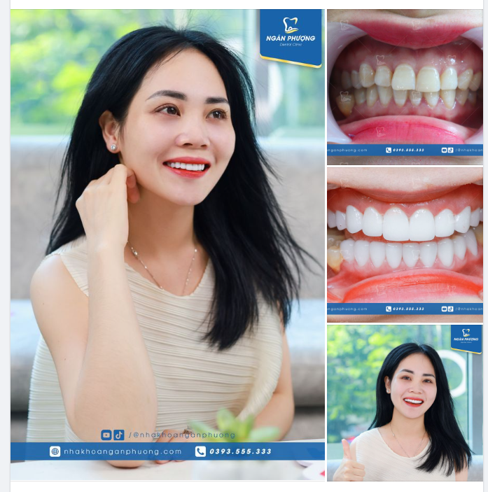 Tặng em một đóa hoa quỳnh  Hỏi rằng răng sứ đẹp xinh nhường nào?