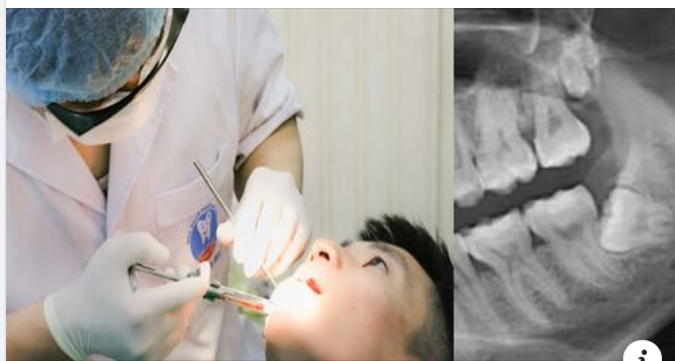 Hướng dẫn chăm sóc sau khi nhổ răng khôn