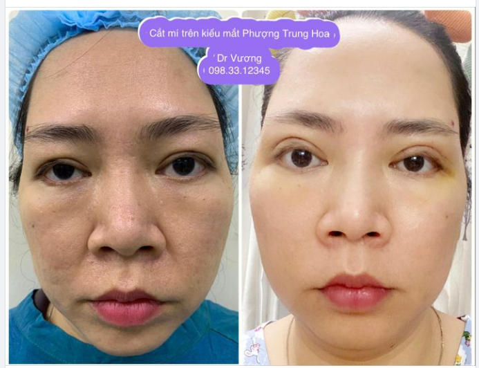 Khám lại mí trước ngày cắt chỉ với Dr Vương