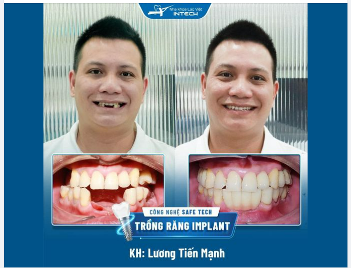 "Lựa chọn về Việt Nam trồng răng Implant tại Lạc Việt Intech là quyết định đúng đắn nhất của tôi..."