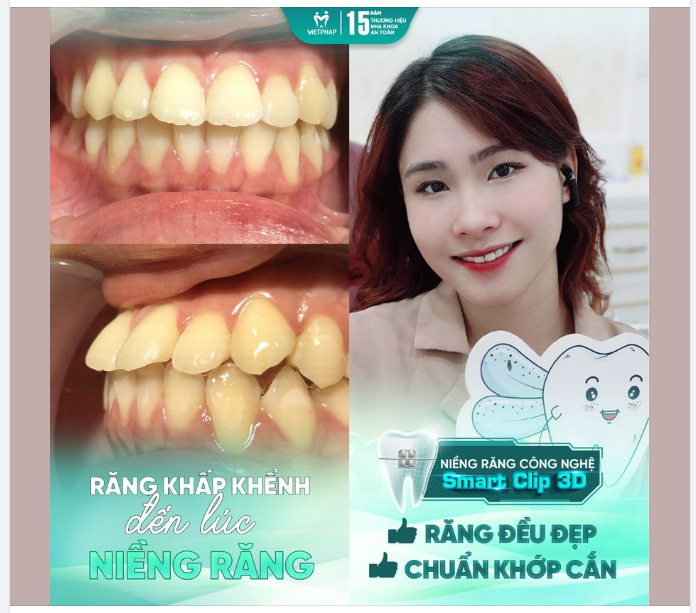 Sự thay đổi đầy ngoạn mục của bạn Phạm Thị Thanh Thảo sau khi niềng răng