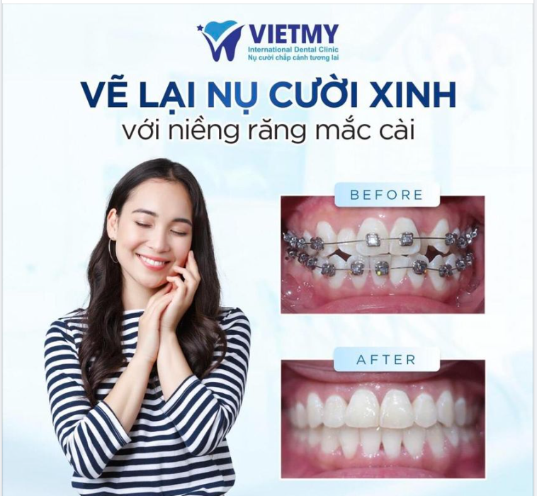 7 NỖi Đau SẼ BiẾn Ngay LẬp TỨc Sau Khi NiỀng RĂng TẠi Nha Khoa Qt ViỆt MỸ 0451