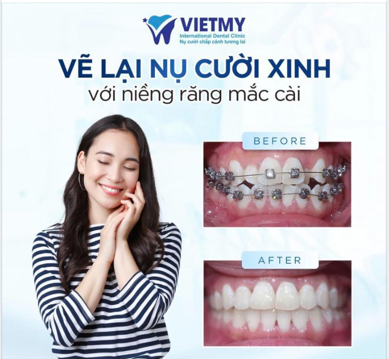 7 NỖI ĐAU SẼ BIẾN NGAY LẬP TỨC SAU KHI NIỀNG RĂNG TẠI NHA KHOA QT VIỆT MỸ