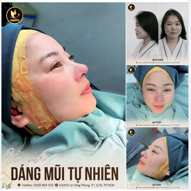 TỪ 8X TRẺ THÀNH 9X CHỈ SAU NÂNG MŨI