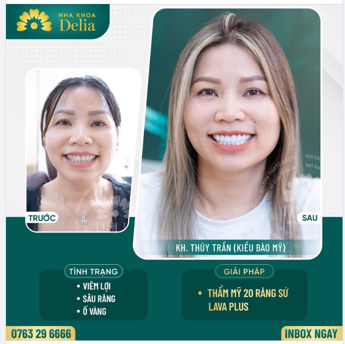 "Vượt hơn 13.000 km từ Mỹ về Việt Nam, chị Thúy Trần (kiều bào Mỹ) đến với nha khoa Delia