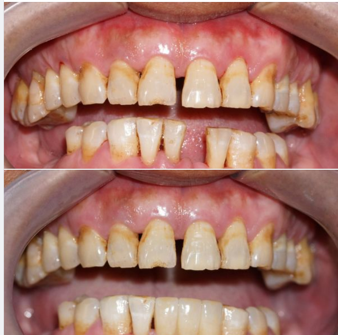 Khi nào thì cầu răng sứ có ưu điểm hơn so với cấy ghép Implant?
